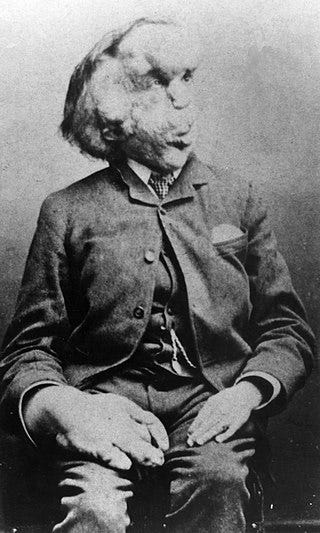 Learning to Love the Elephant Man