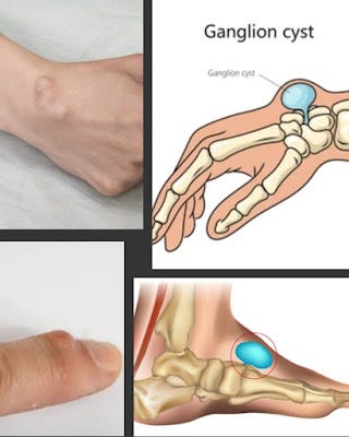 Ganglion Cysts and Physiotherapy. Ganglion Cysts and Physiotherapy | by ...