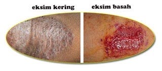 3 OBAT HERBAL GATAL EKSIM DE NATURE DI METRO (100% KUALITAS TERBAIK)