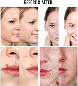 Paradise Skin Tag Remover Review [Updated] Shocking Reviews Exposed