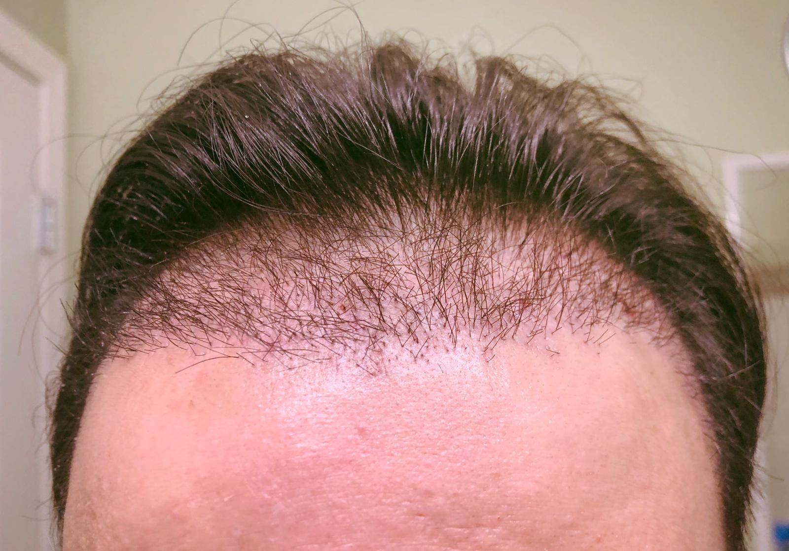 Week 3. By day 20 (one day before the start of… | by My Hair ...