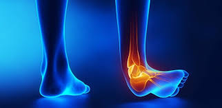 Visual of Ankle Injury | https://www.istockphoto.com/photos/ankle-anatomy