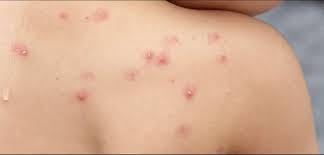 L-MPOX u t-tfal