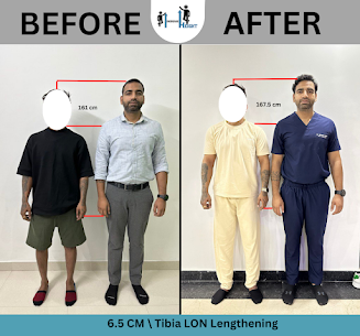 Limb Lengthening Surgery Cost in India — Complete Guide by Height Increase Info