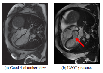 Brief Review — Automatic Left Ventricular Outflow Tract Classification for Accurate Cardiac MR…