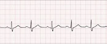 Imagem do exame de coração (eletrocardiograma).