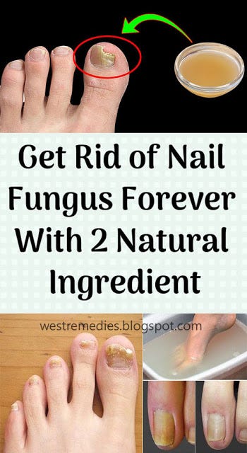 Get Rid of Nail Fungus Forever With 2 Natural Ingredient - Emankney ...