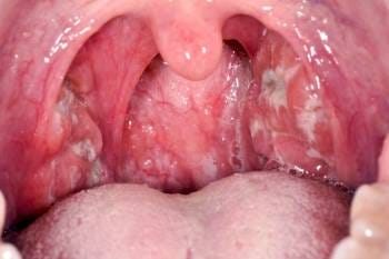 What is a throat infection?. A throat infection, also known as ...