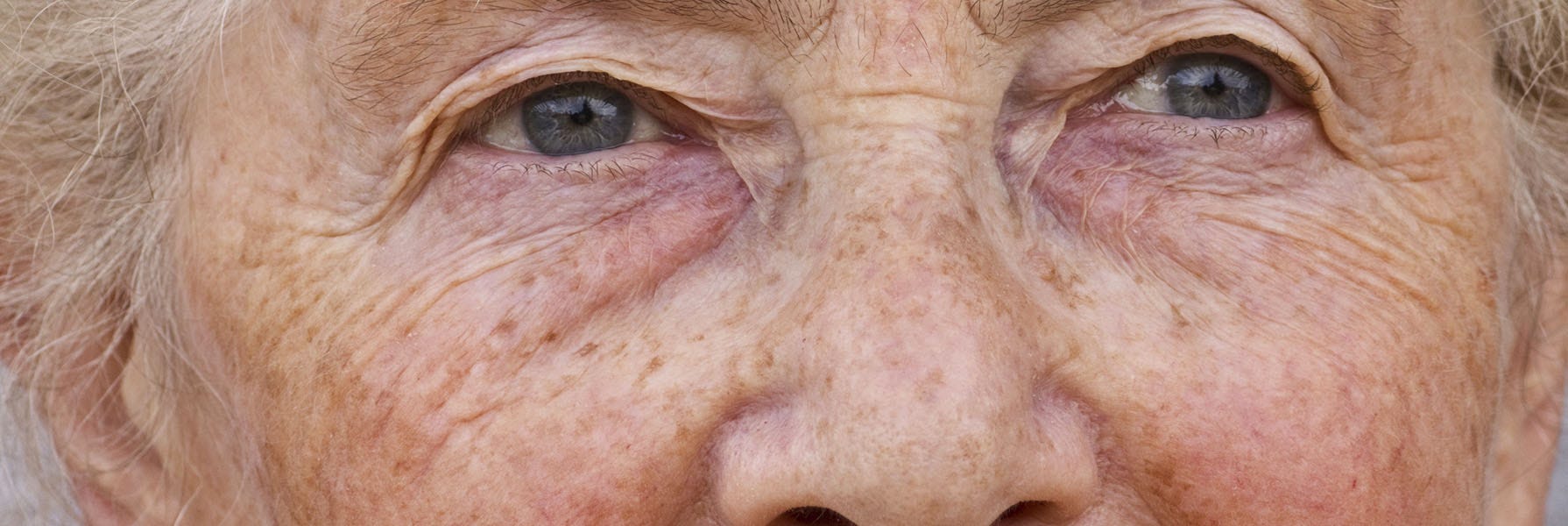 Age Spots: Causes and Treatment