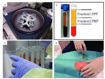 Beyond PRP: The Molecular Mechanics of Exosomes in Tissue Regeneration and Aesthetics