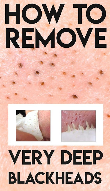 View of Safe and Effective Ways to Remove Deep Blackheads - Emily Blunt - Medium