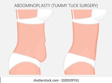 Detailed How Can I Get A Free Tummy Tuck Wallpaper for Your Screen Detailed How Can I Get A Free Tummy Tuck Wallpaper for Your Screen