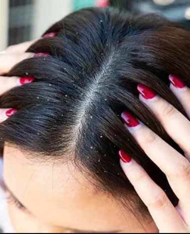 Healthy Scalp And Shiny Hair: The Dandruff Treatment Hair Spa In Chennai