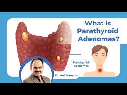 Parathyroid Adenomas