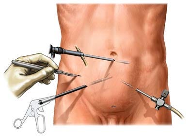 Why Laparoscopic Surgery Is Best In Case Of Sports Hernia?