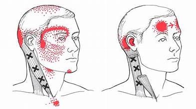 Why Your Headaches, Eye Strain, and Acid Reflux Might Be Caused by This One Neck Muscle