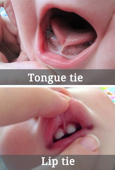 what-is-a-lip-tie-in-babies-by-fashion-blogger-medium