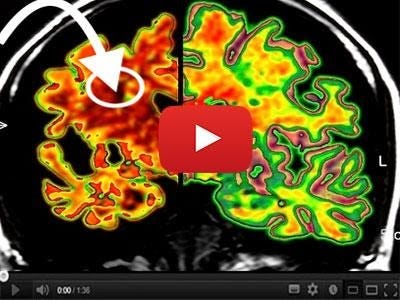 What really happens inside your brain when you have vertigo