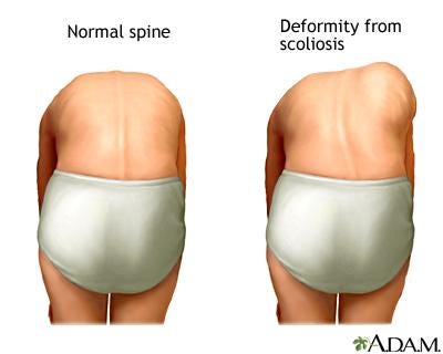 Types of Scoliosis: Adolescent Idiopathic Scoliosis