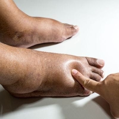 Understanding Feet Swelling during Winter: Causes, Effects, and Solutions