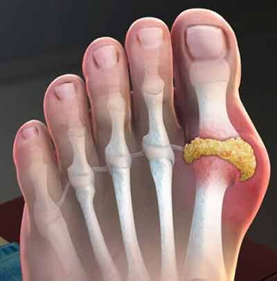 How does gout affect the body over time, and what are the potential ...