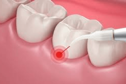 Laser Dentistry Bangalore — Advanced & Comfortable Dental Care