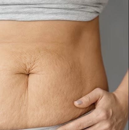 Stretch Mark Solutions: Banishing Those Battle Scars, by Essentialskincare