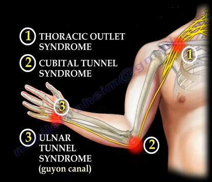 Cubital Tunnel Syndrome. The ulnar nerve originates from the…