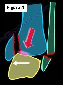 Ankle Fractures. There are many of important topics…, by Nabil Ebraheim, Thrive Global