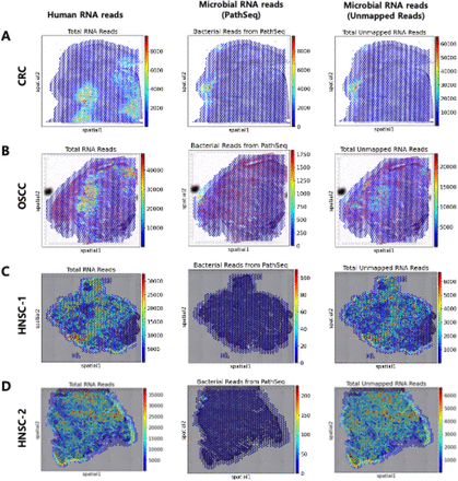 Analysis of Unmapped RNA-seq Data from Cancer Spatial Transcriptome to Decipher Cancer Microbiome