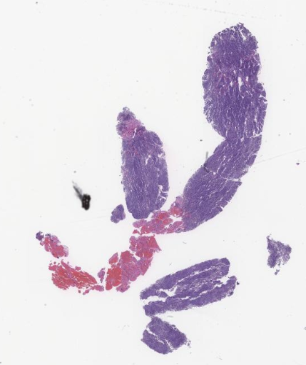 Nodular Lymphocyte Predominant Hodgkin Lymphoma - Siba El Hussein, MD ...