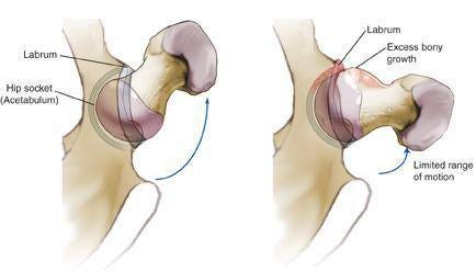 Femoroacetabular Effects: Causes, Symptoms and Treatment | by Devang |  Medium