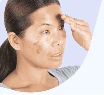 The Secrets to Clear Skin: Tips to Erase Dark Spots and Pigmentation