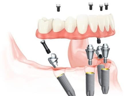 Dallas-Fort Worth Top Dental Solutions: Snap-On Dentures, All-on-4 Implants