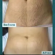 Before and after clinical results showing deep stretch mark reduction