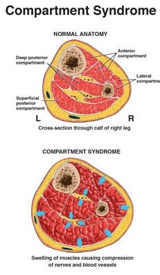 What is Compartment Syndrome?. Compartment syndrome happens when