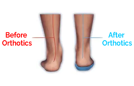 How to Correct Supination: Stretches, Exercises, Orthotics, & More