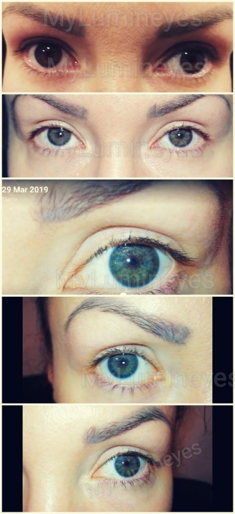 Laser procedure can turn brown eyes blue