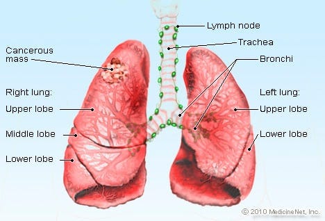 Lung Cancer Prediction Using SQL Data Manipulation and Cleaning | by ...