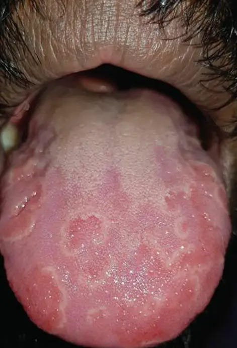 Fissured Tongue: All You Need To Know — DentistMaa | by Nitish Singla |  Medium