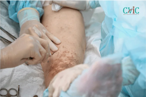 Vascular Surgeon in Indore | Expert Diagnosis and Advanced Vascular Treatment at CVIC Indore