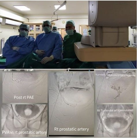 Prostatic artery embolisation — Dr. Yadav Munde