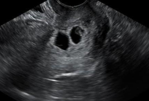 Mama’s Journey : “Two Lines, Two Heartbeats 🤰”
