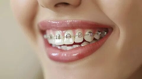 how long does braces treatment take? a complete guide