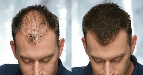 Diagnosis Hair Loss & Best Hair Specialists in Lahore | by abdulrahman
