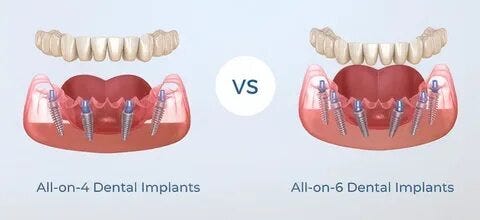 all-on-4 vs all-on-6 dental implants