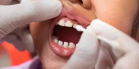 the role of fluoride and dental sealants in preventive dental care