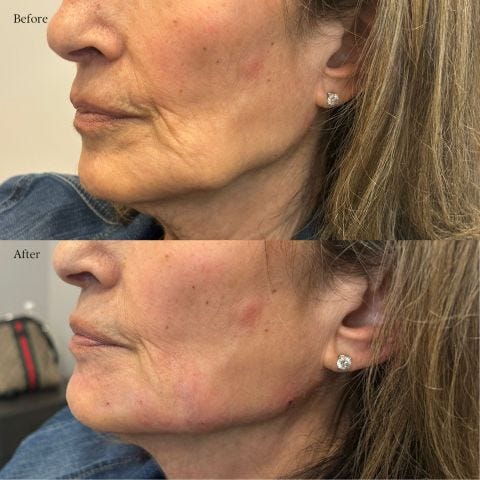 Dermal Fillers Niagara Falls