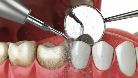 Professional Teeth Cleaning: Why It’s Essential for Oral Health