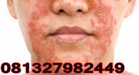 Berikut Ini Nama Obat Gatal Exim Basah dan Kering